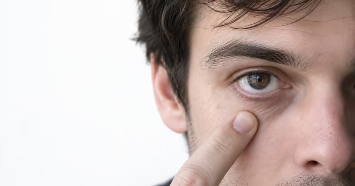"Ferritin Face" and Low Iron Symptoms Explained | DocTap